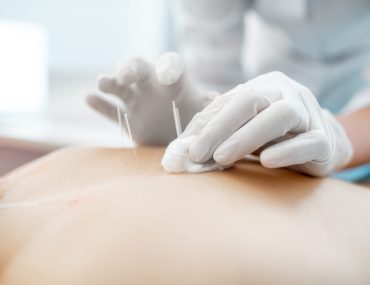 Close-up of the acupuncture medical treatment with special needles